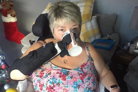 A woman wearing a Mitt prosthetic arm drinks from a cup she's holding thanks to the gripper attachment