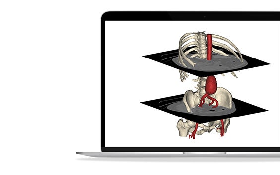 An abdominal aortic aneurysm model with the bones as reference. It shows 2 axial slices of the CT scan to show how we go from images to a 3D model.
