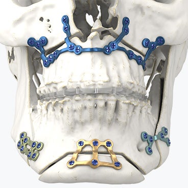 Advancing TMJ Arthroplasty Surgery: Precision Solutions for Tumor