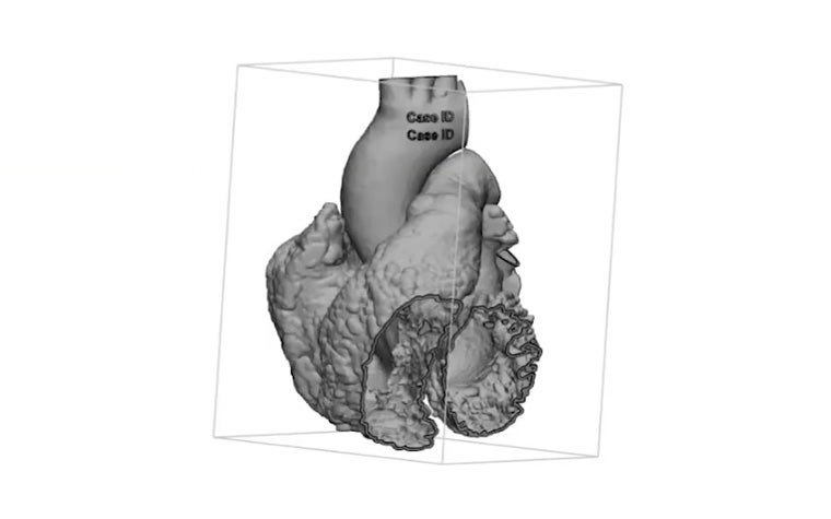 How to Create a Heart Model in Materialise Mimics for 3D Printing