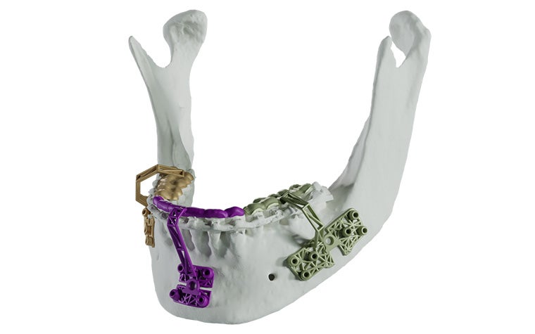 A model of a human jaw with Materialise 3D-printed guides attached as used for MIOS.