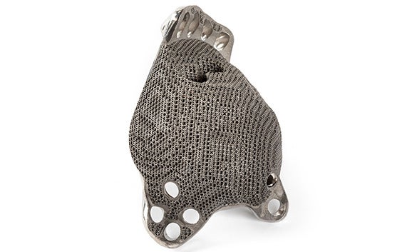 Vue de la face arrière texturée d'un implant de hanche personnalisé