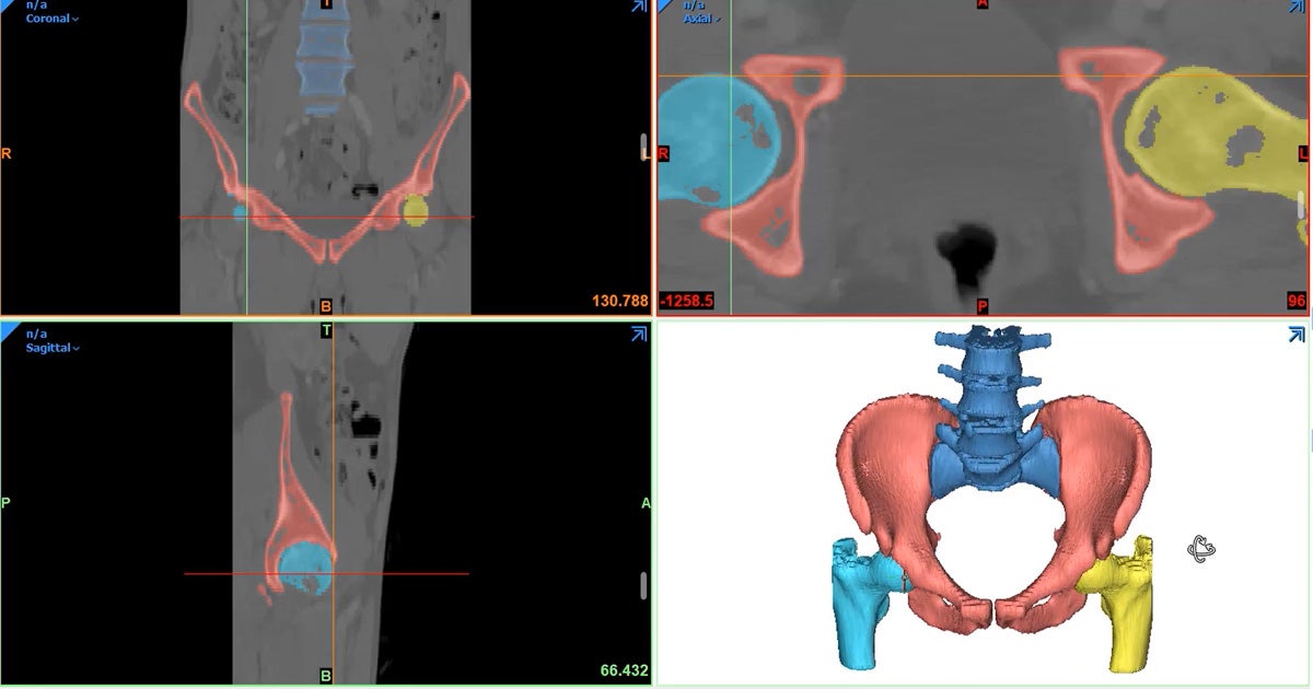 Tutorial: How to Use the Split Mask Tool in Materialise Mimics Core