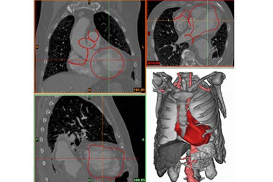 Tools being applied  to the images of anatomy, such as thresholding, region growing and morphological operations