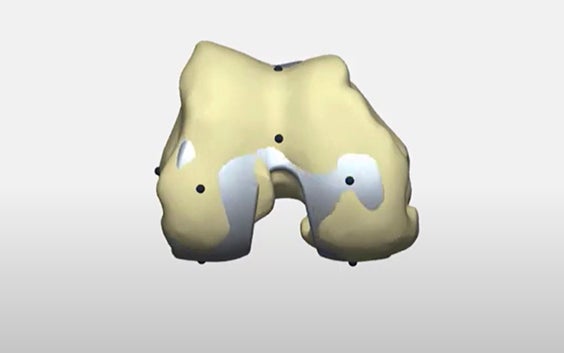 How to personalize knee alignment with 3D planning and guides