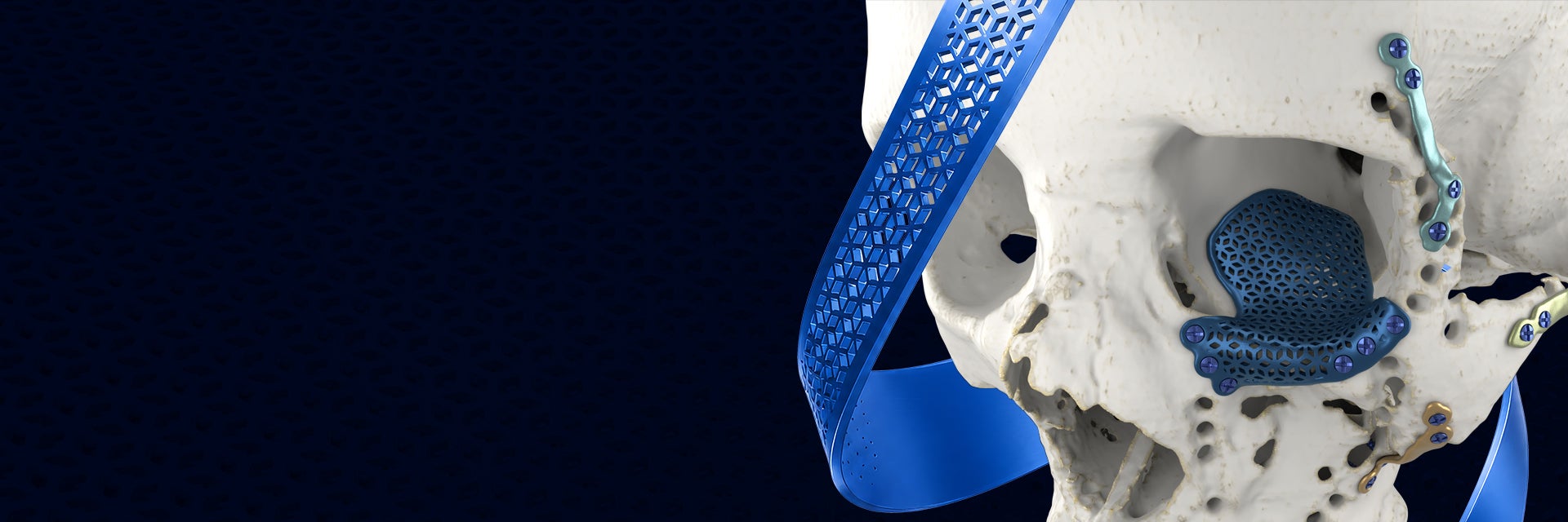 Skull model with various 3D-printed CMF implants in place