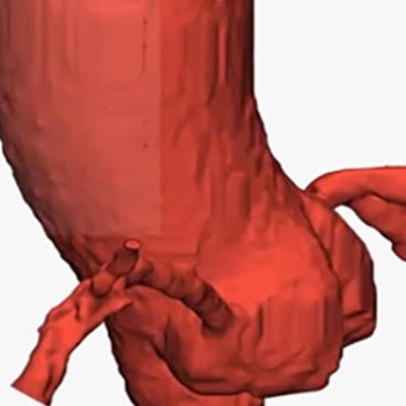 How to Segment and Analyze Coronaries in Mimics Innovation Suite