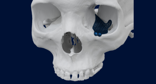 Model of a skull with a 3D-printed, personalized orbital implant attached