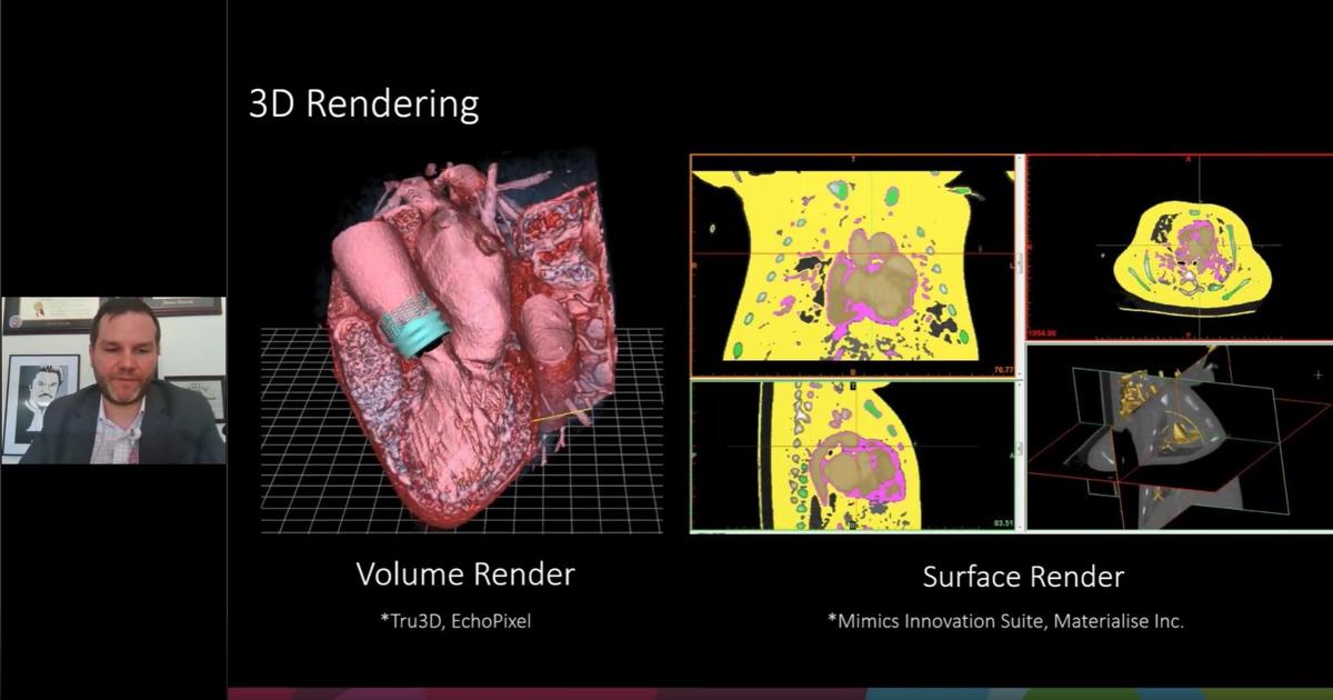 Pmct Volume Rendering Webinar: Virtual Implantation of MCS Devices | Materialise