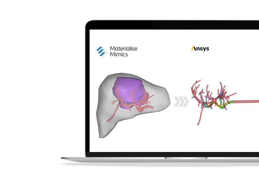 Segmentation and simulation shown in one workflow from the liver on the left and the injection on the right shown on a laptop screen.