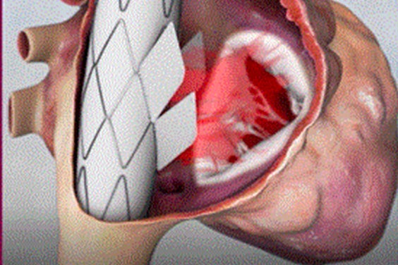 Tricuspid Valve Replacement: 3D Technology Accelerates Life-Saving Ideas