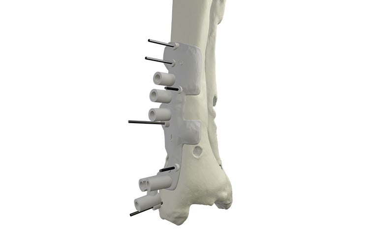 materialise-osteotomies-solutions-3d-printed-guides-indication-ankle-model.jpg