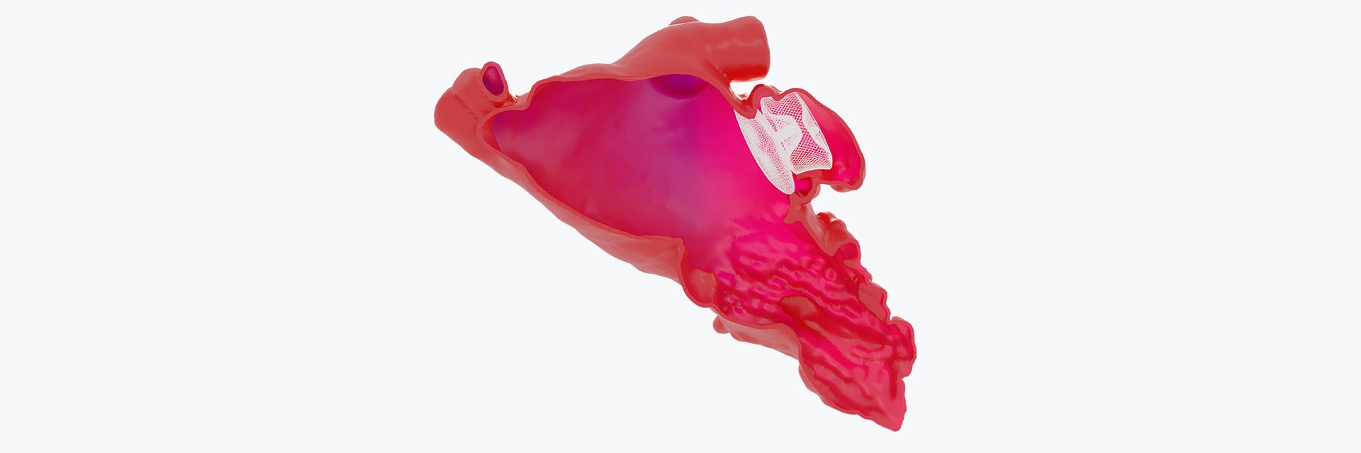 A cross-section of an LAAO device within a 3D virtual heart model.