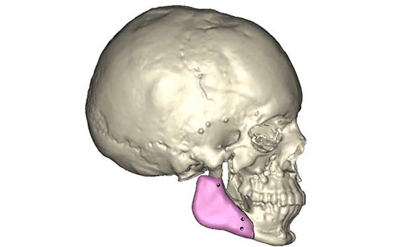 Revolutionizing Cranio-Maxillofacial Surgeries with 3D Planning and Custom Implant Design