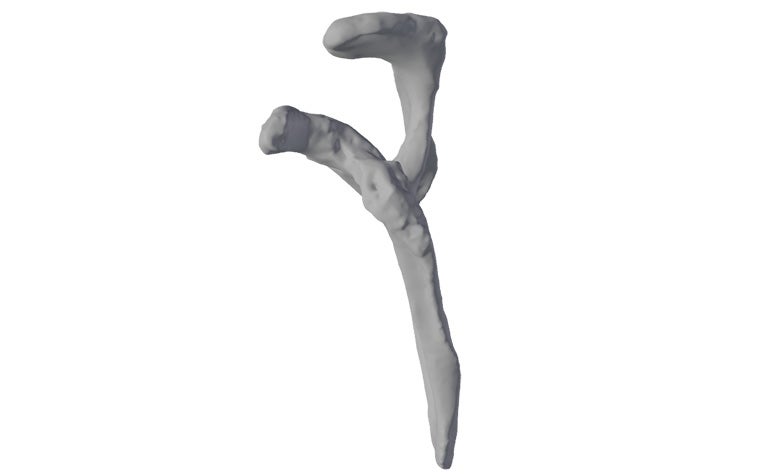 Digitales Bild eines vollständig erodierten Glenoidgewölbes