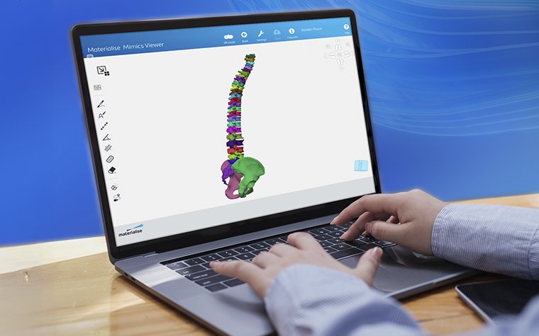 Hands using the keyboard of a laptop with the Materialise Mimics Viewer software, showing a segmented 3D model of a patient's spine and hips