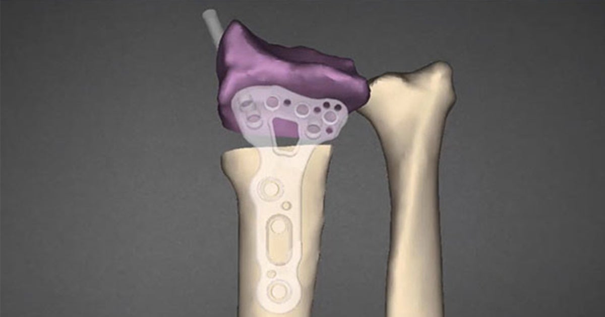 Revista Brasileira de Ortopedia - Treatment of Distal Radio Vicious  Consolidation: Corrective Osteotomy Through 3D Printing  Prototyping<sup>*</sup>