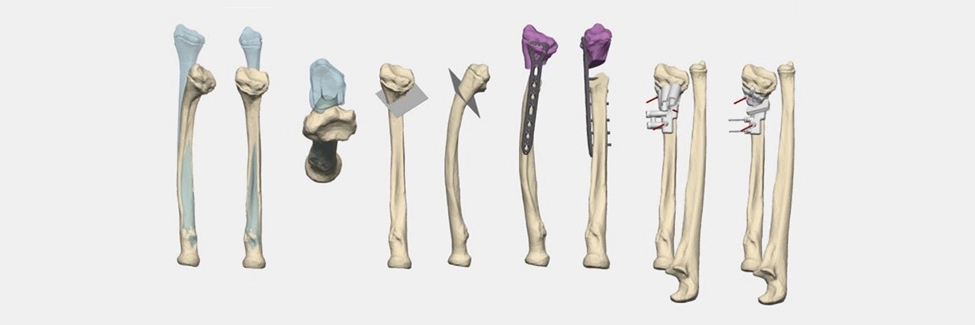 Various 3D renders of bones with 3D-printed surgical guides attached