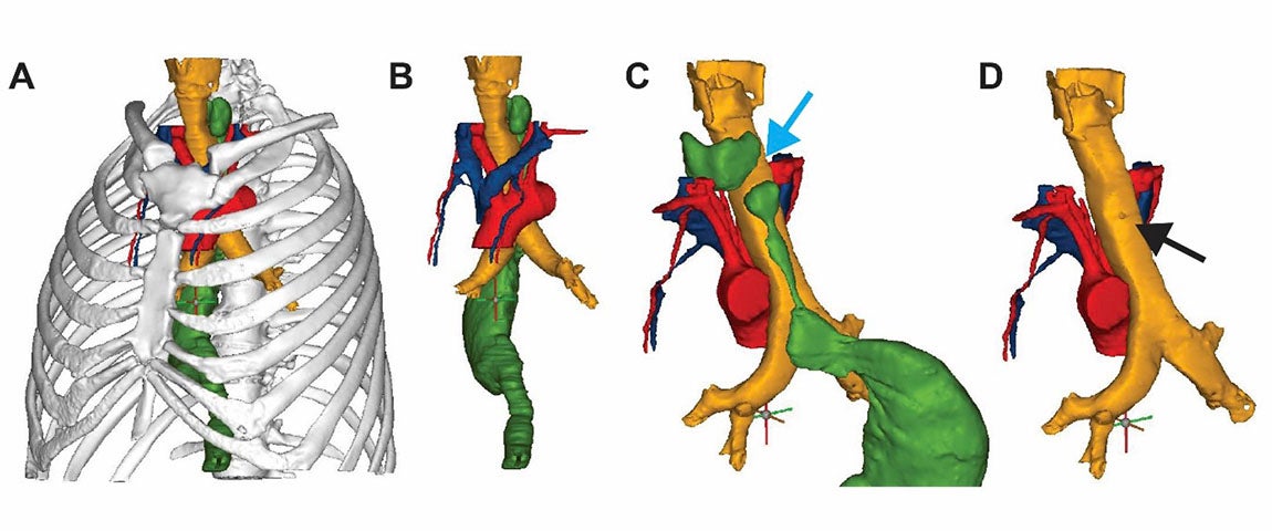 3D-Darstellung der Anatomie des Patienten mit mediastinalen Komponenten in verschiedenen Farben.