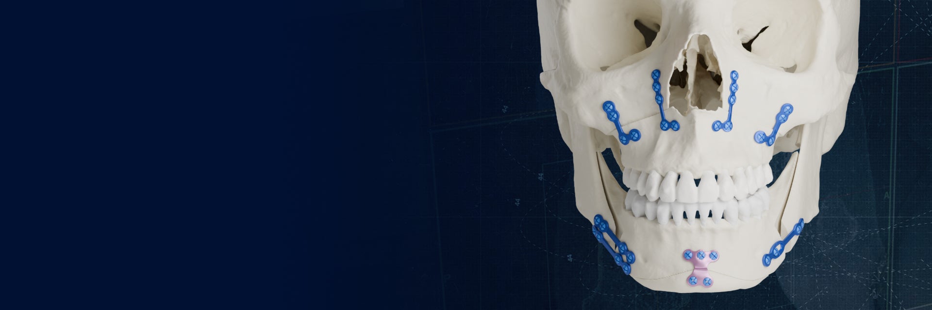 hd-healthcare-professionals-cmf-indications-orthognathic-standard-plates.jpg