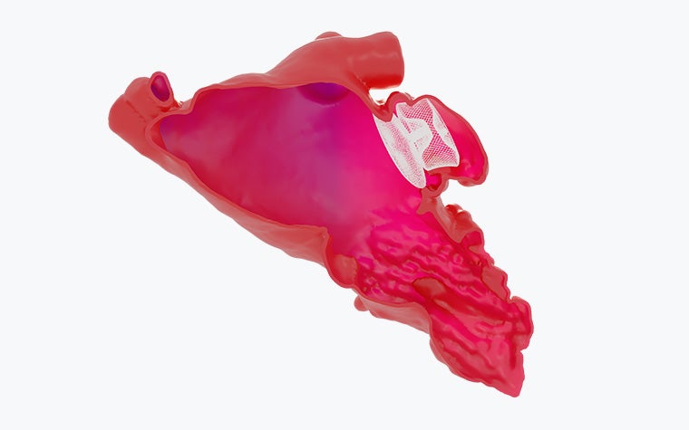 A cross-section of an LAAO device within a 3D virtual heart model.