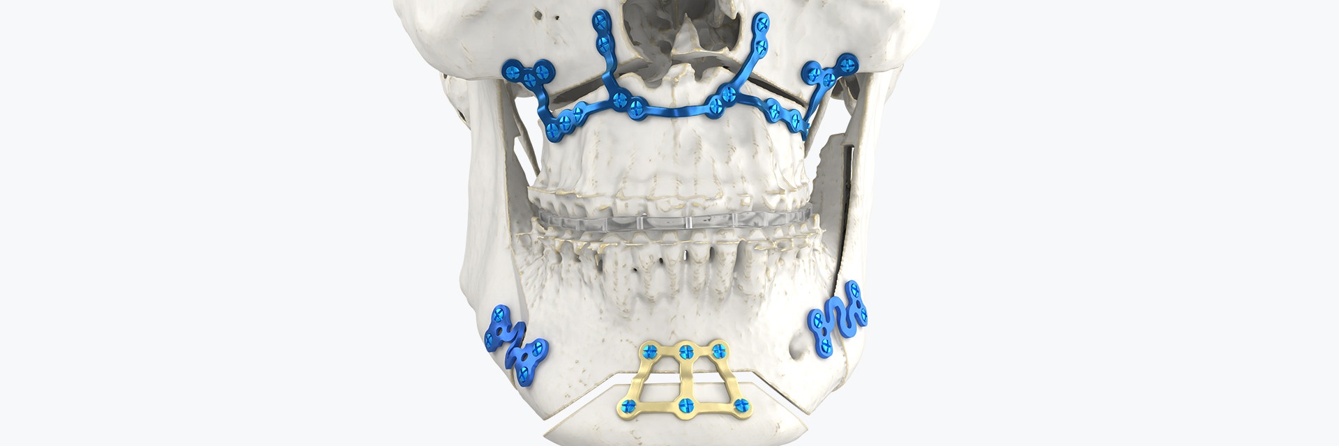 Advantages of Using S-Plate for Bilateral Sagittal Split Osteotomy