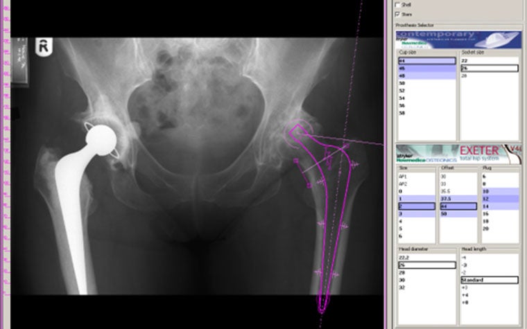 A view of preoperational planning using OrthoView software from 2003.