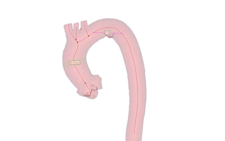 How to Analyze the Centerline of the Aorta with Materialise Mimics Core