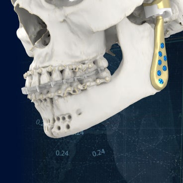 TMJ Total Arthroplasty System | Materialise