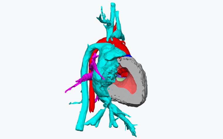 A 3D anatomical rendering of a child's heart and surrounding blood vessels in multiple colors, highlighting internal chambers and vascular structures.
