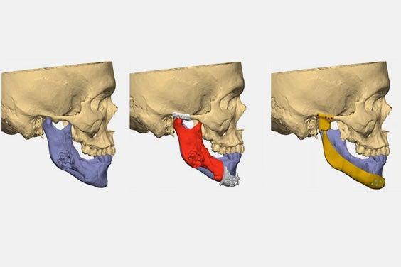 3 profile views of a skull model displaying various jaw implants.