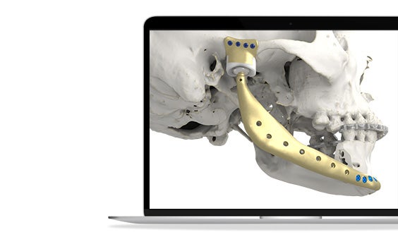 Laptop screen showing the side view of a skull model with a metal implant along the jaw