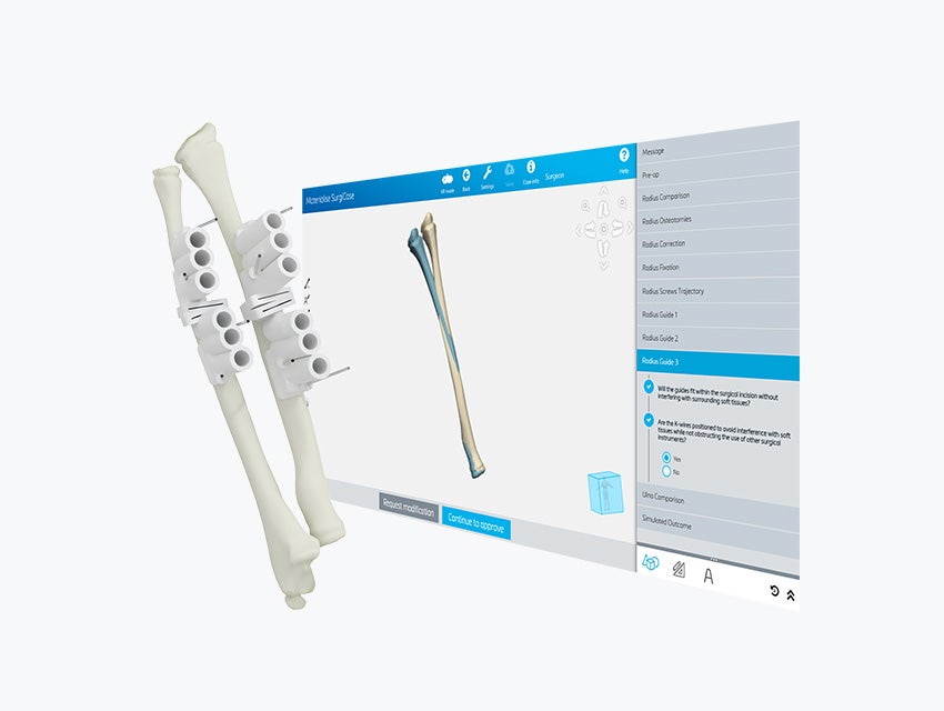 Zwei Knochenmodelle mit 3D-gedruckten, personalisierten Bohrschablonen vor einem Bildschirm mit der Anatomie des Patienten in Materialise SurgiCase