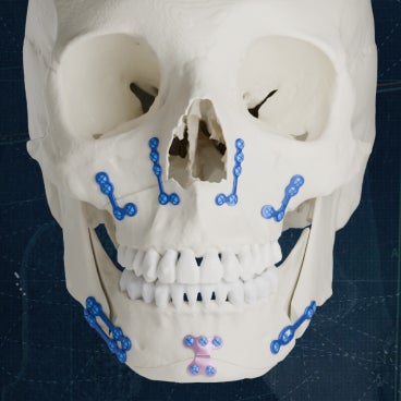 hc-healthcare-professionals-cmf-indications-orthognathic-standard-plates.jpg