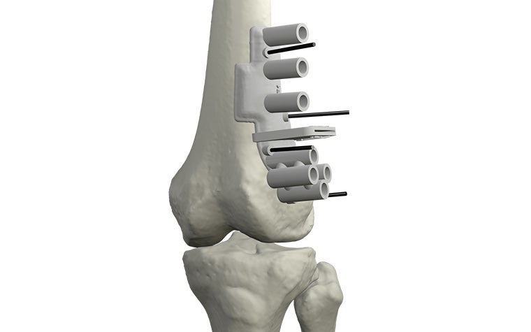 materialise-osteotomies-solutions-3d-printed-guides-indication-knee-model.jpg