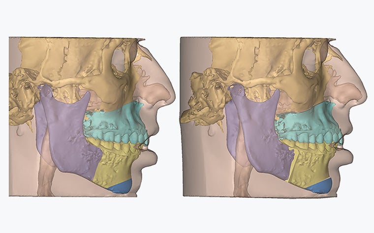 Digital, profile view of a patient's skull with the jaw segmented, showing the difference before and after surgery