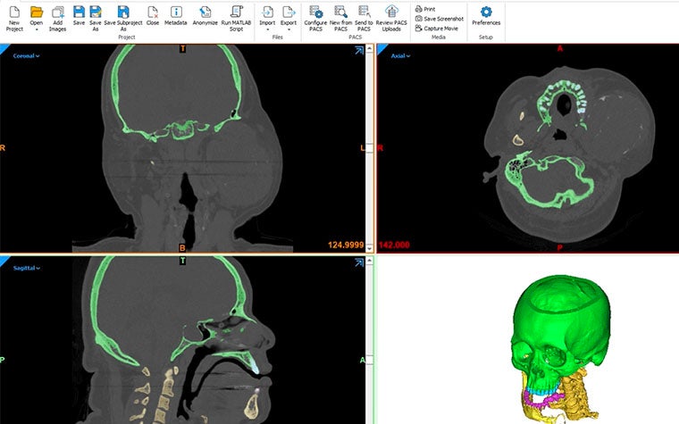 Scans and 3D models of a skull in Mimics software