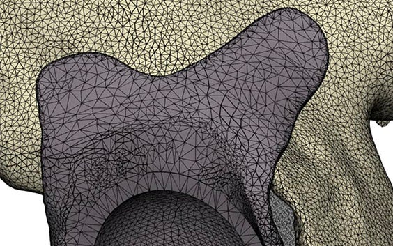 STL file of a personalized implant in anatomy