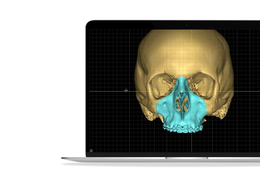 A 3D render of a human skull with a highlighted section in cyan on a laptop screen. 