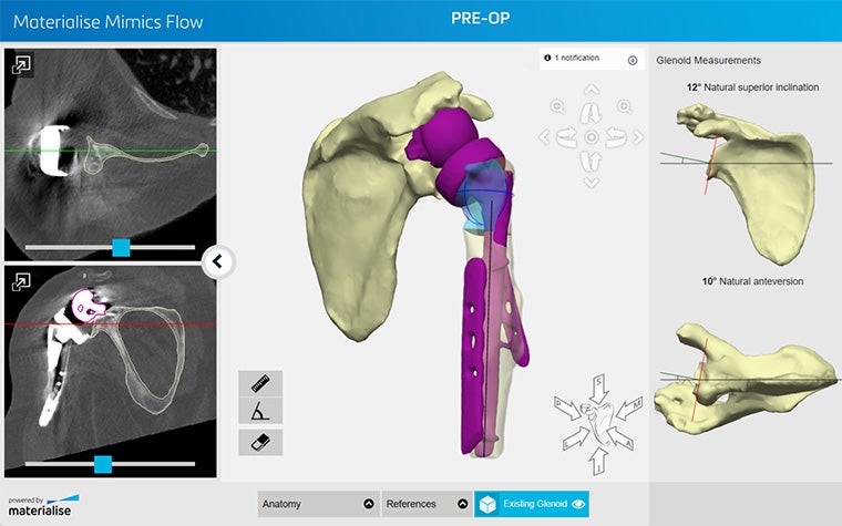 Vista de planificación de la artroplastia de hombro en Mimics Flow, incluidas las mediciones de las exploraciones del paciente y una vista del implante personalizado en un modelo 3D del hombro del paciente.