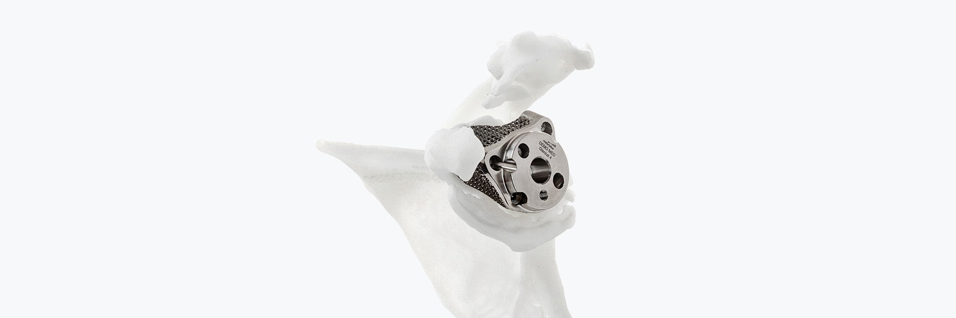 3D-printed Glenius shoulder implant in a shoulder model