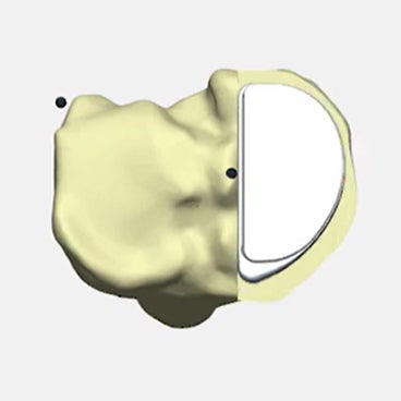 7 Steps to 3D Plan a Persona® Partial Knee