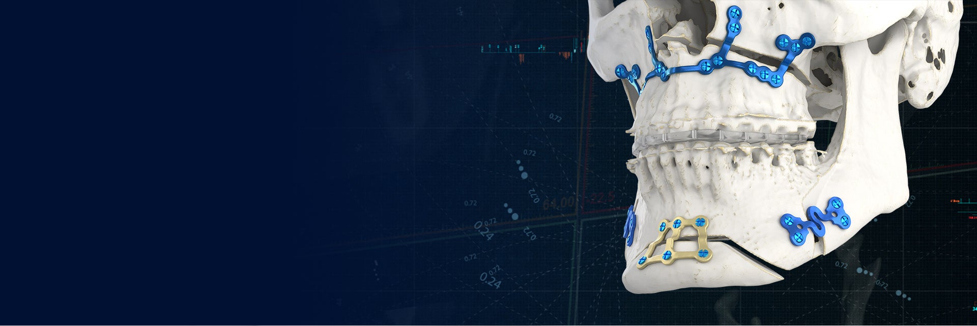 Angled view of a skull model with 3D-printed, personalized plates in place to connect displaced skull fragments