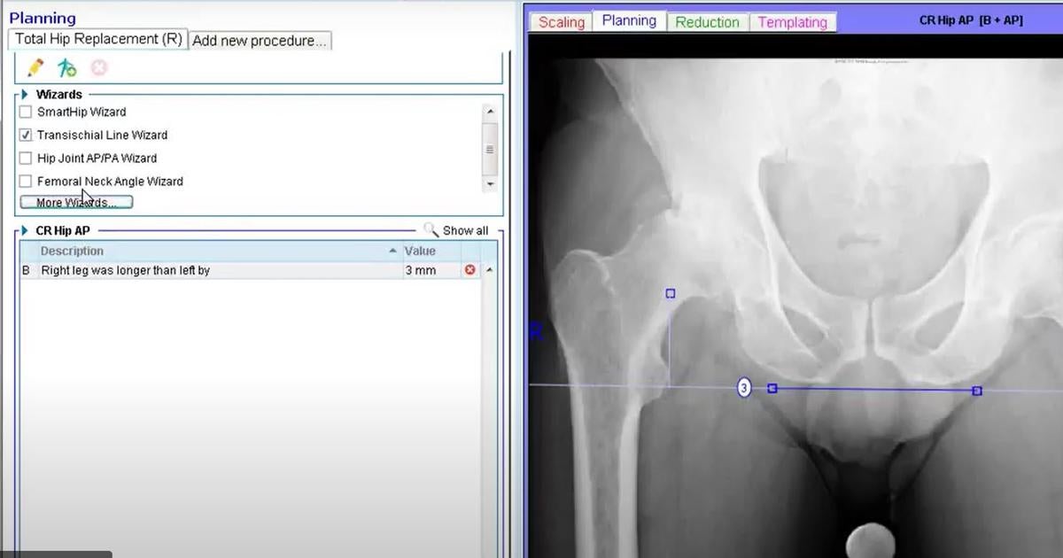 Tutorial Planning Panel in Materialise OrthoView