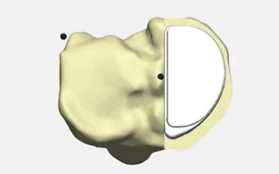 7 Steps to 3D Plan a Persona® Partial Knee