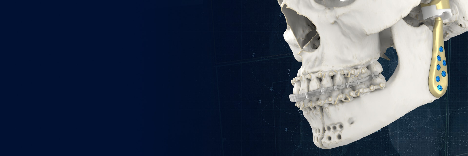 TMJ Total Arthroplasty | Personalized Implants and Guides