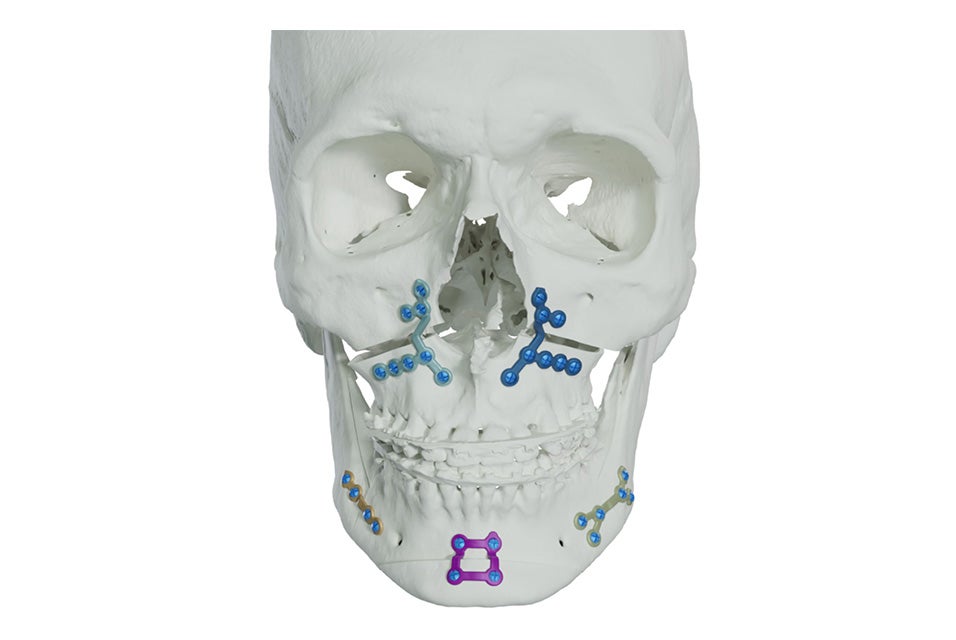 A front facing skull with Materialise implants in various locations.