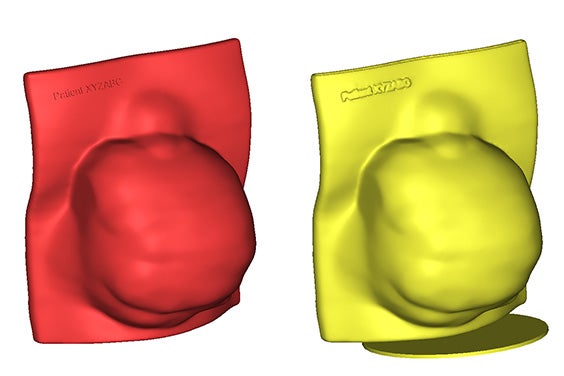 3D-printed bolus radiotherapy device held in a hand.