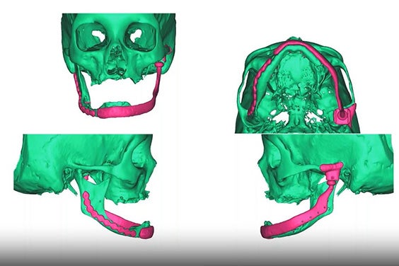 Postoperative result of the surgery illustrated through 4 angles of a patient scan