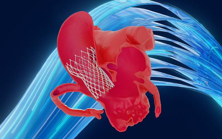 Tavr Program Optimal TAVR Planning in a Young Patient with a Small Anatomy